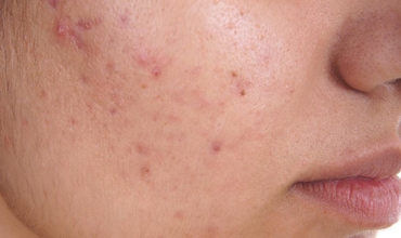 Best Acne Treatment Clinic in Greater Noida