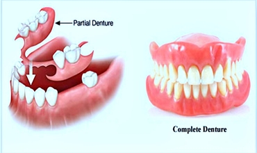 Best Complete/Partial Denture Clinic in Greater Noida