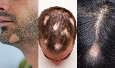 Best Hair Loss(Alopecia)/Dandruff Treatment Clinic in Greater Noida