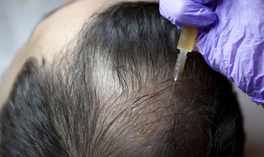 Best Hair PRP Treatment Clinic in Greater Noida