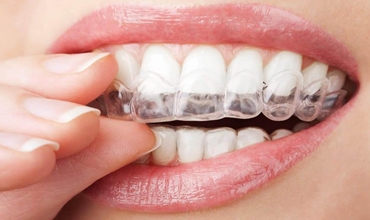 Best Non-Visible Braces Clinic in Greater Noida