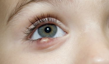 Best Stye Treatment Clinic in Greater Noida