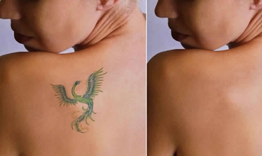 Best Tattoo Removal Clinic in Greater Noida