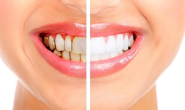 Best Teeth Whitening Clinic in Greater Noida