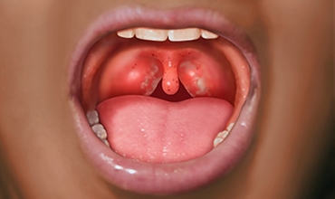 Best Tonsillitis Treatment Clinic in Greater Noida