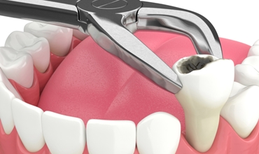 Best Tooth Extraction Clinic in Greater Noida