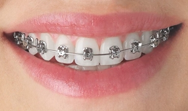 Best Visible Braces Clinic in Greater Noida