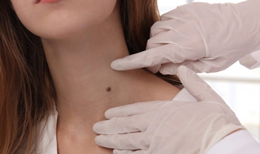 Best Wart Mole Skin Tag Removal Clinic in Greater Noida